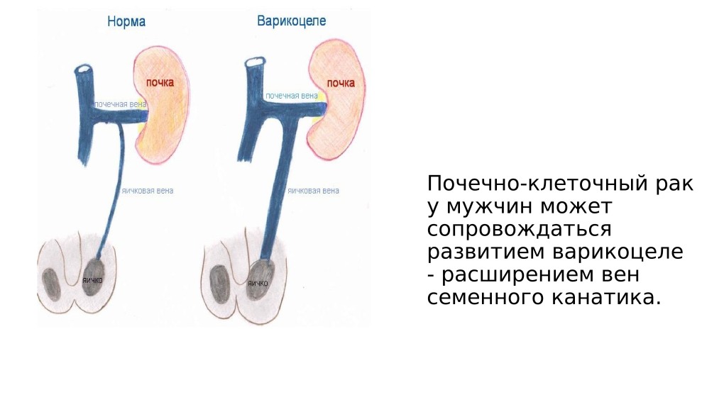 Варикоцеле презентация