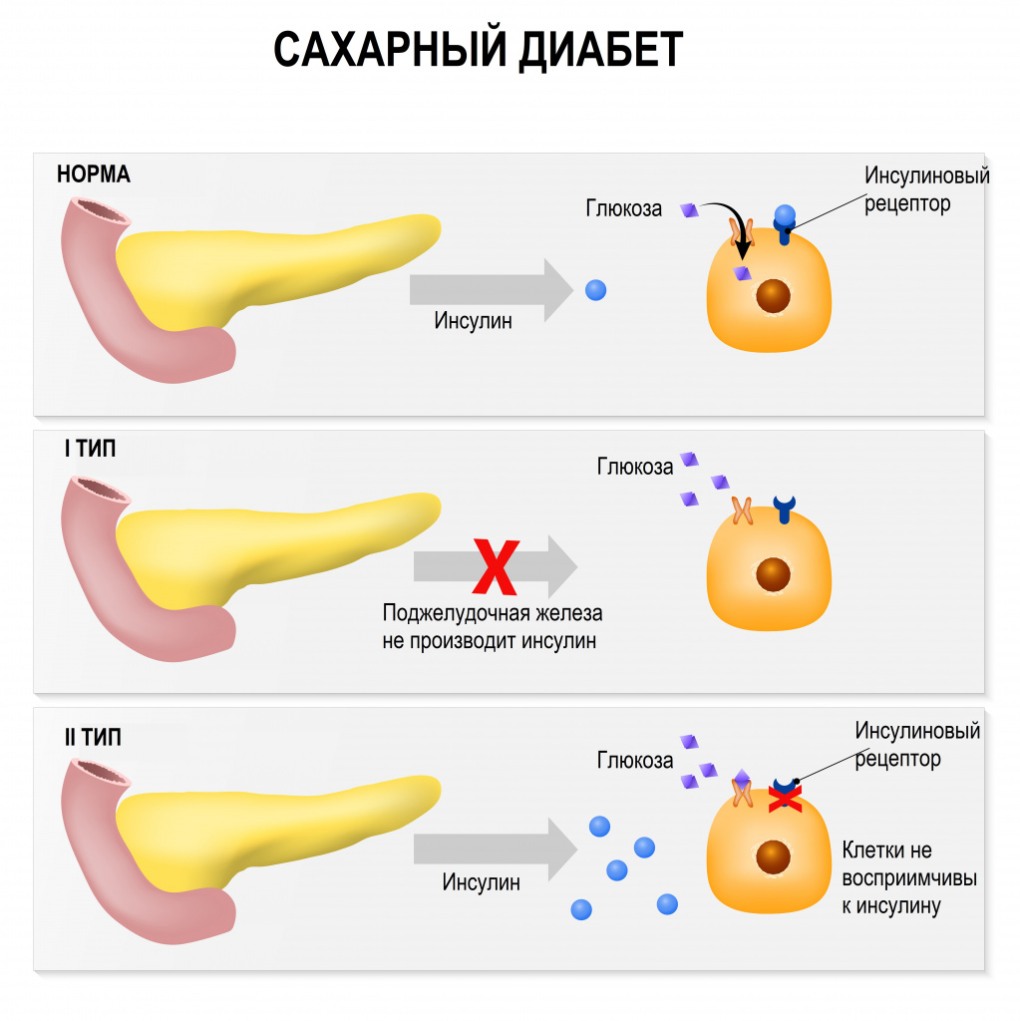 Инсулинозависимый сахарный диабет этиология