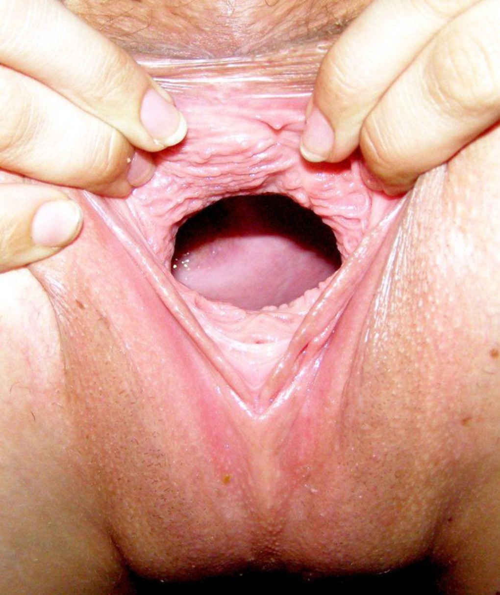 Нормальное здоровое влагалище